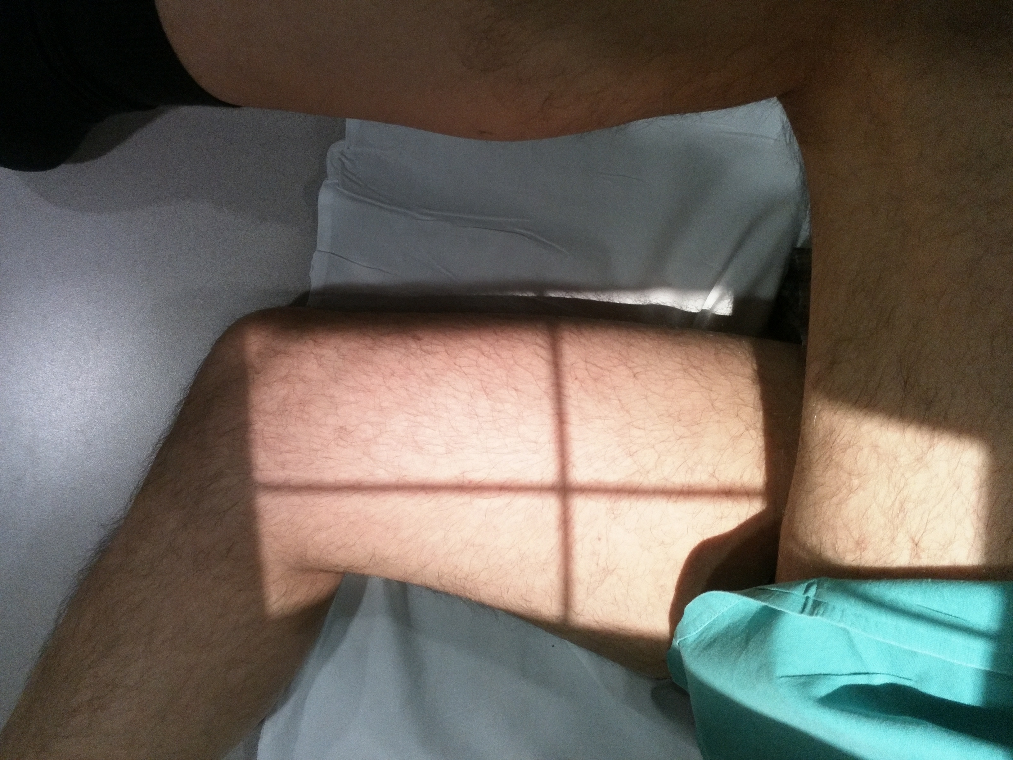 Proyección Lateral de Fémur